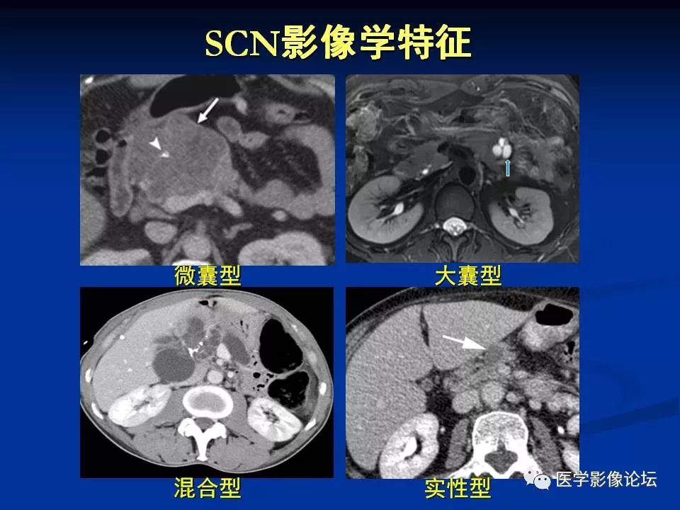 【PPT】胰腺囊性肿瘤影像学诊断与鉴别诊断