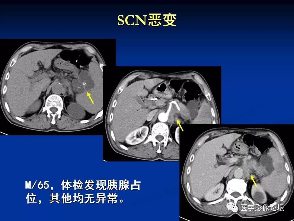 【PPT】胰腺囊性肿瘤影像学诊断与鉴别诊断