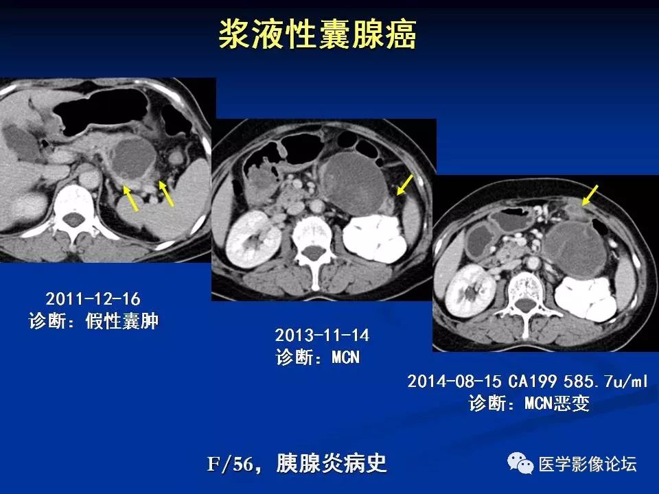 【PPT】胰腺囊性肿瘤影像学诊断与鉴别诊断