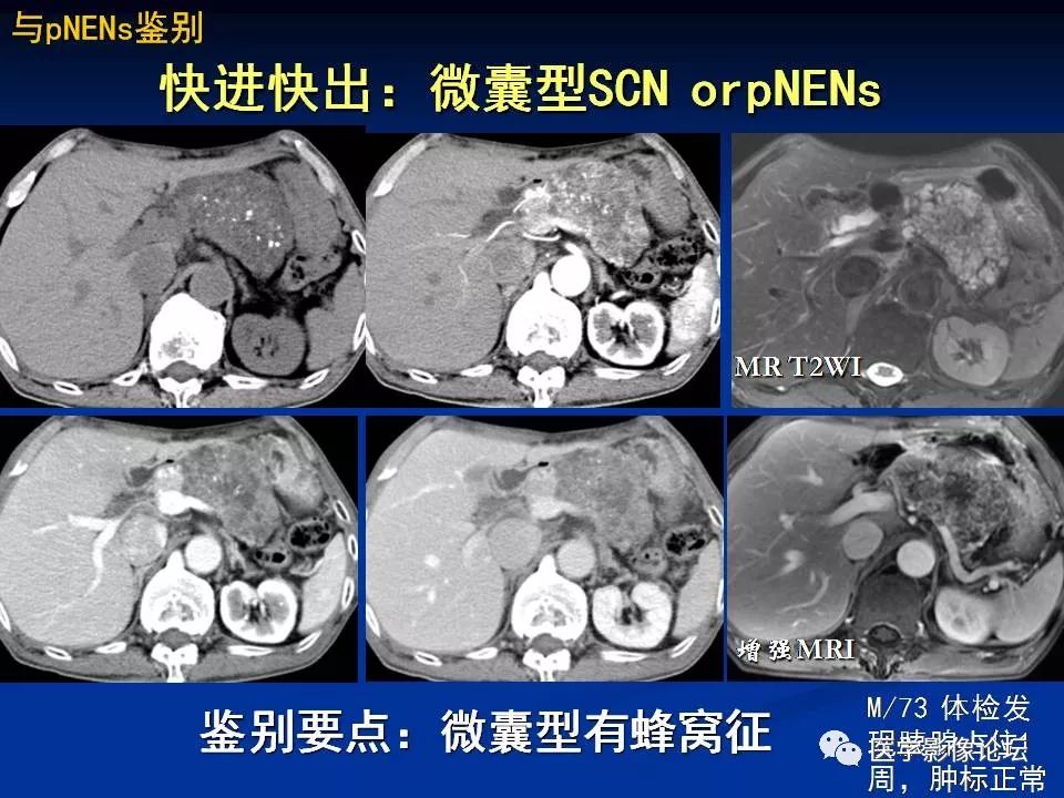 【PPT】胰腺囊性肿瘤影像学诊断与鉴别诊断