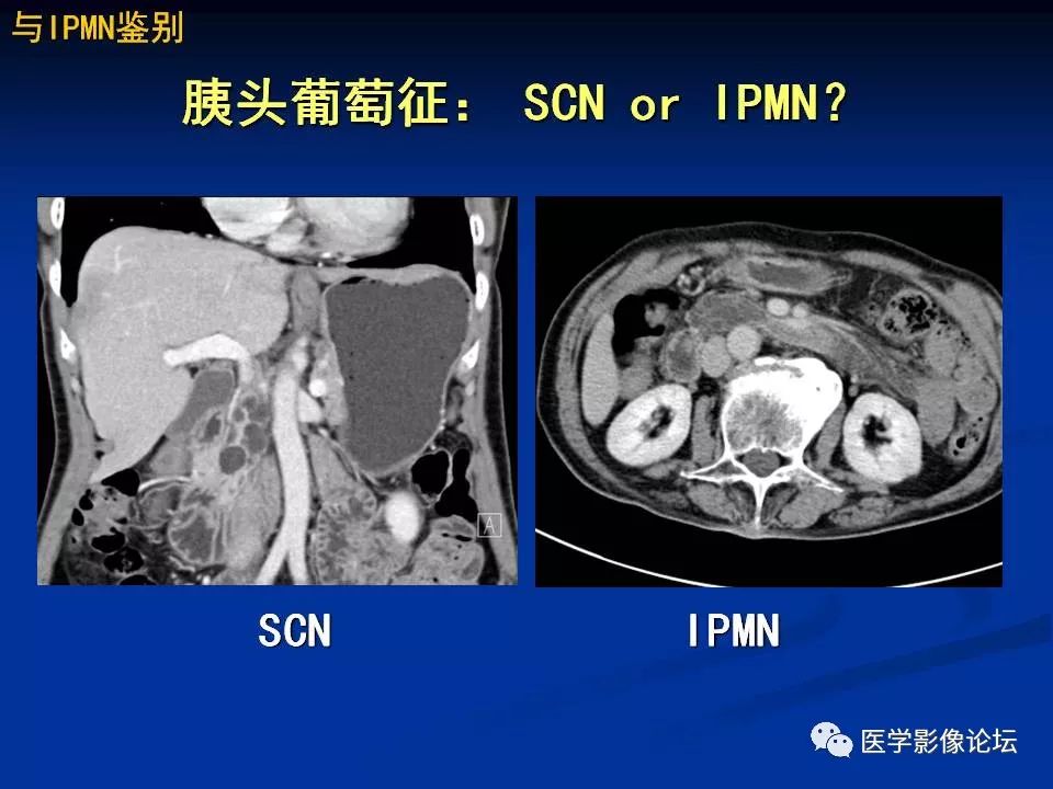【PPT】胰腺囊性肿瘤影像学诊断与鉴别诊断