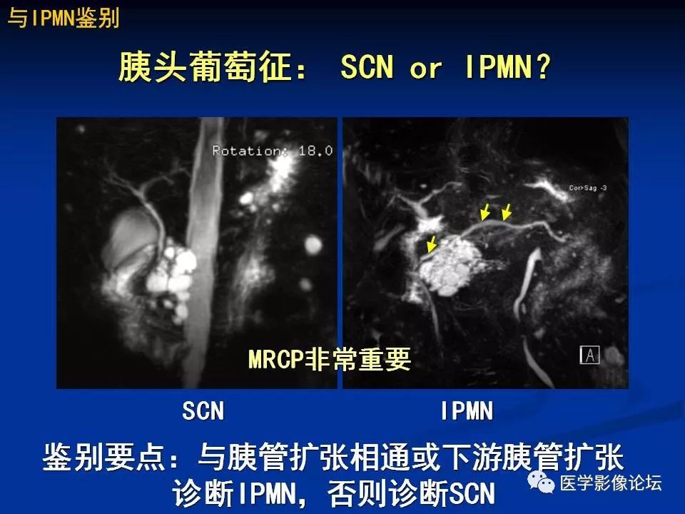 【PPT】胰腺囊性肿瘤影像学诊断与鉴别诊断