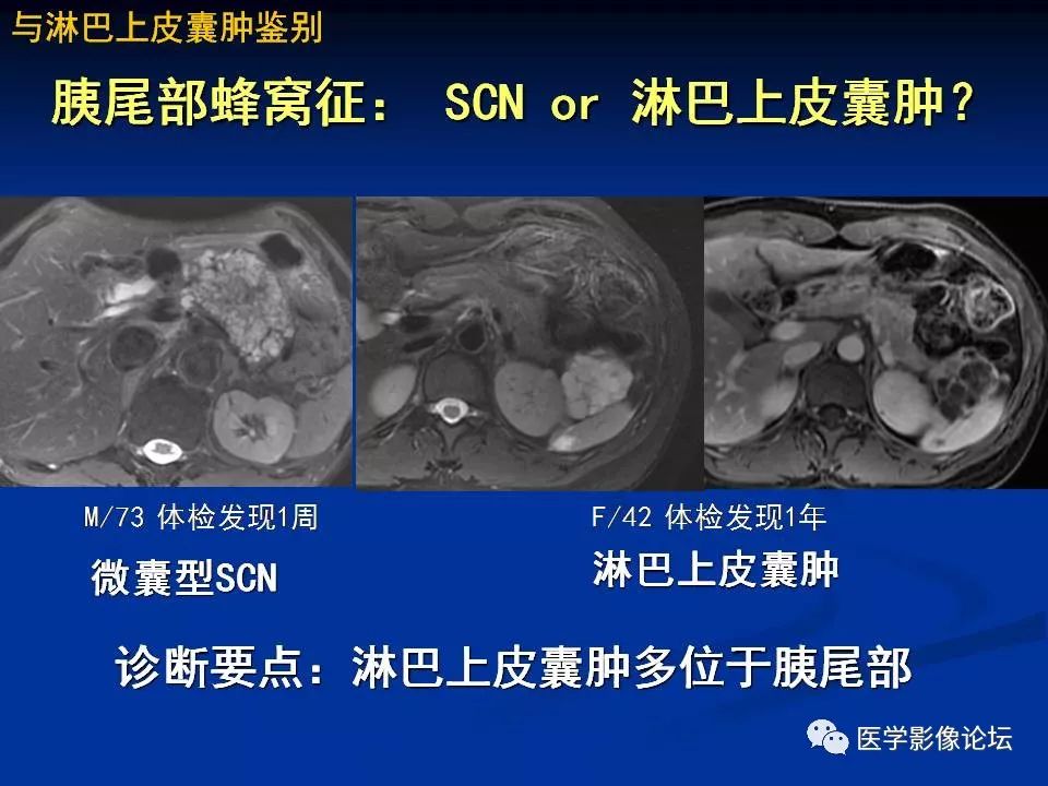 【PPT】胰腺囊性肿瘤影像学诊断与鉴别诊断