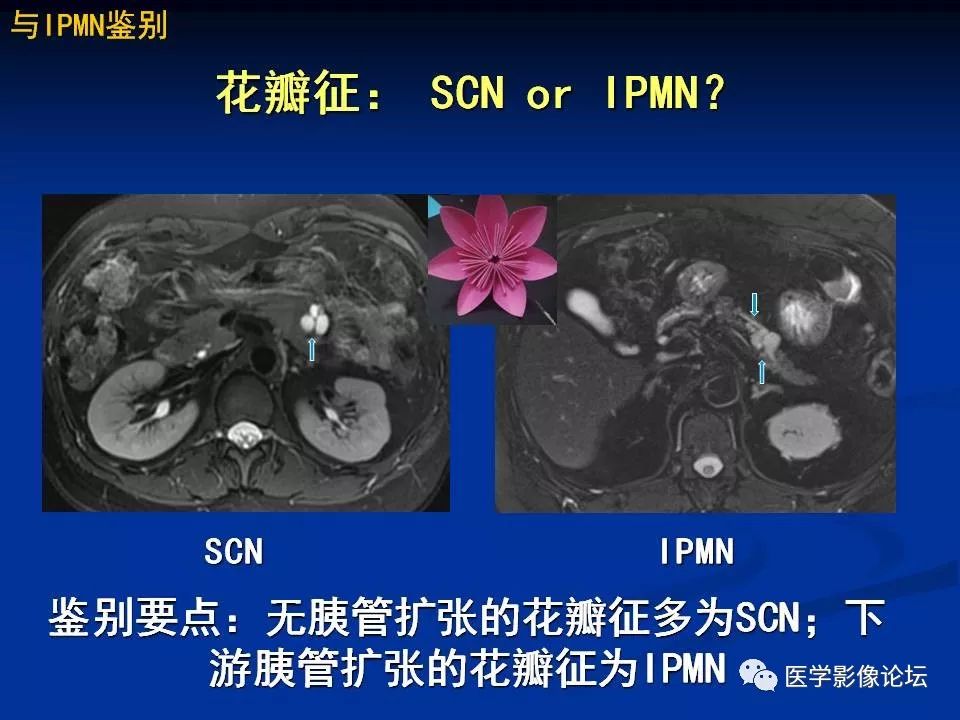 【PPT】胰腺囊性肿瘤影像学诊断与鉴别诊断