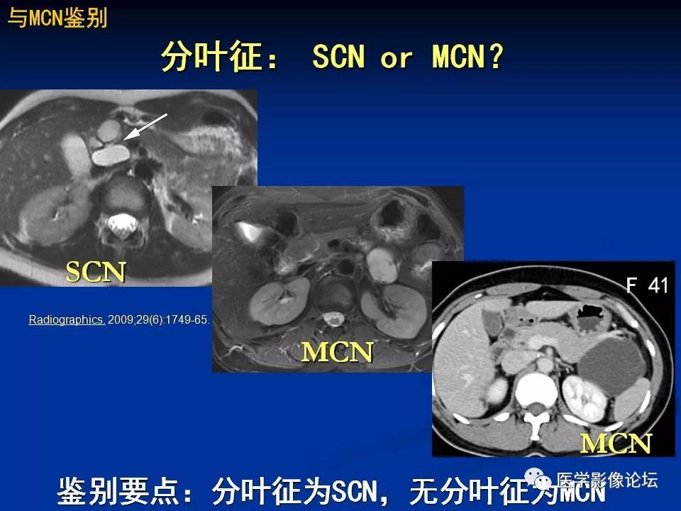 【PPT】胰腺囊性肿瘤影像学诊断与鉴别诊断