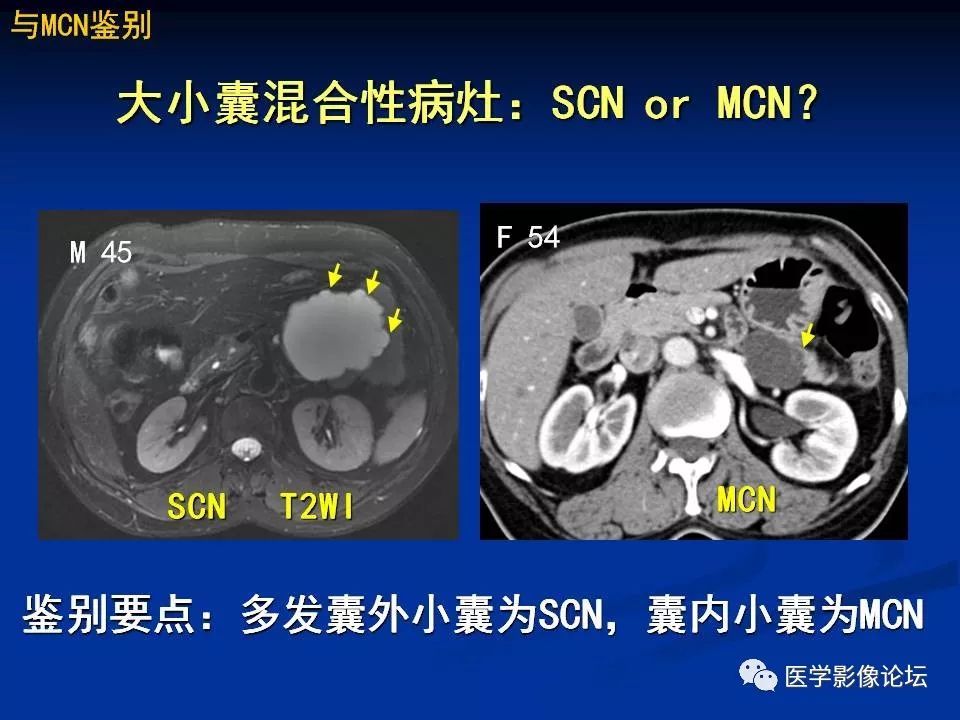 【PPT】胰腺囊性肿瘤影像学诊断与鉴别诊断
