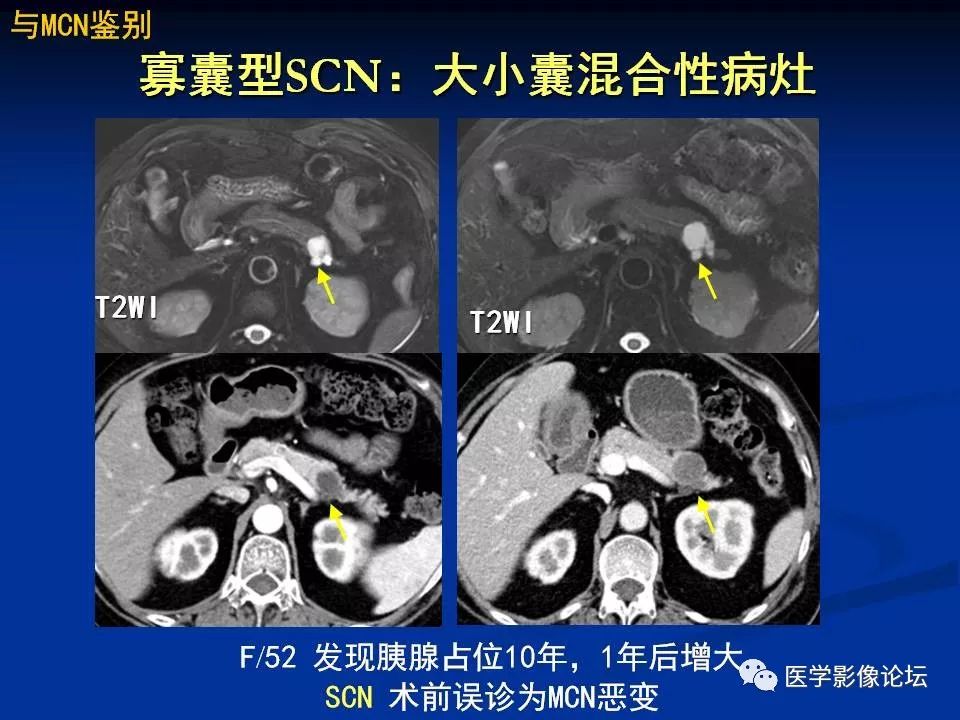 【PPT】胰腺囊性肿瘤影像学诊断与鉴别诊断