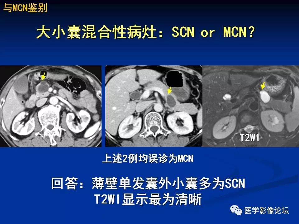 【PPT】胰腺囊性肿瘤影像学诊断与鉴别诊断