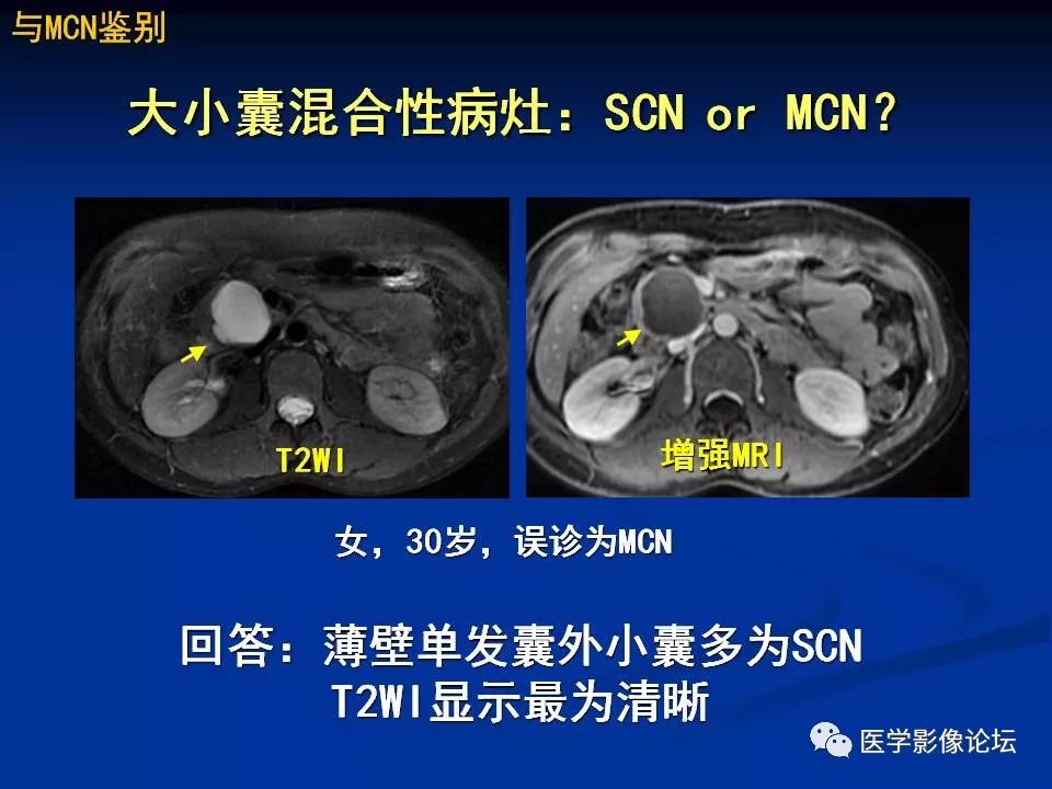 【PPT】胰腺囊性肿瘤影像学诊断与鉴别诊断