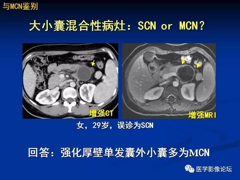 【PPT】胰腺囊性肿瘤影像学诊断与鉴别诊断