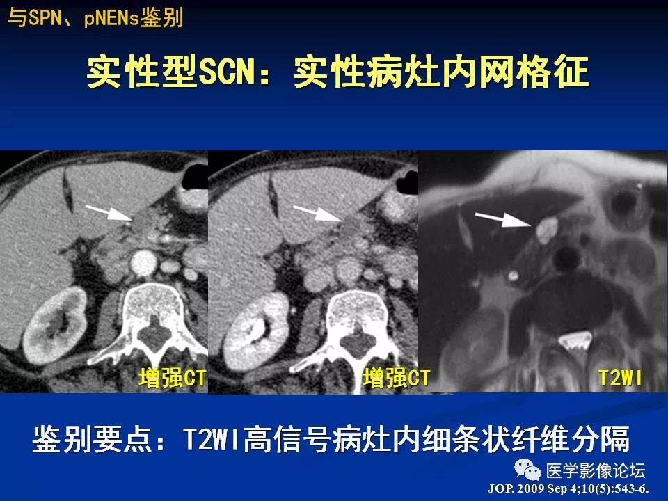 【PPT】胰腺囊性肿瘤影像学诊断与鉴别诊断