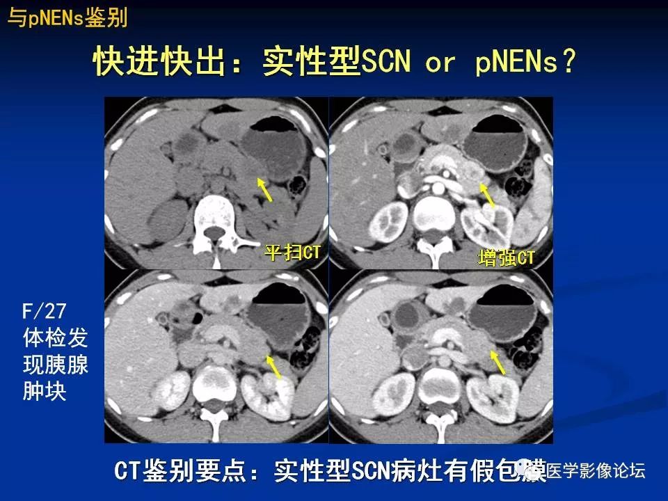 【PPT】胰腺囊性肿瘤影像学诊断与鉴别诊断
