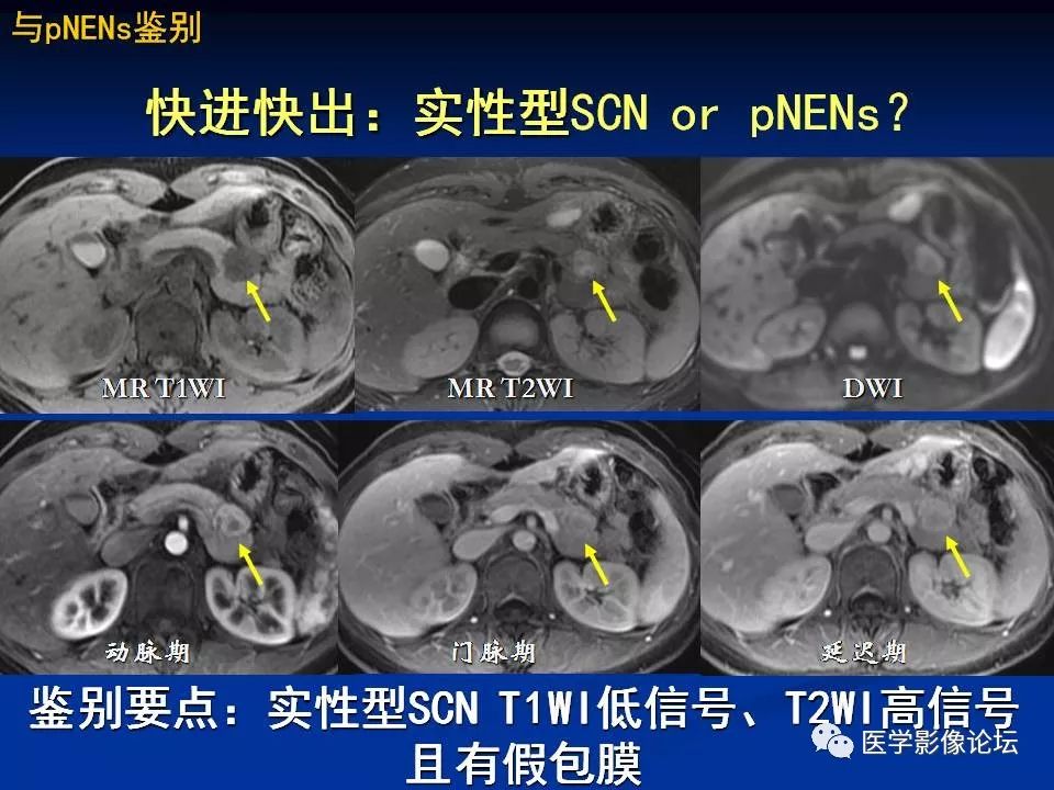 【PPT】胰腺囊性肿瘤影像学诊断与鉴别诊断