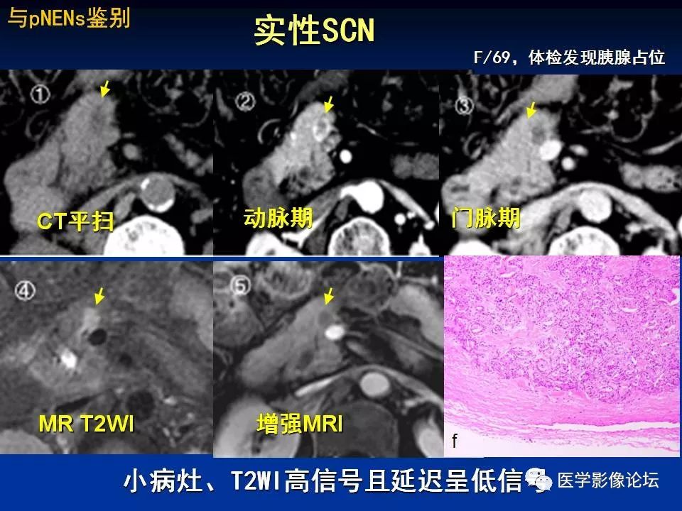 【PPT】胰腺囊性肿瘤影像学诊断与鉴别诊断
