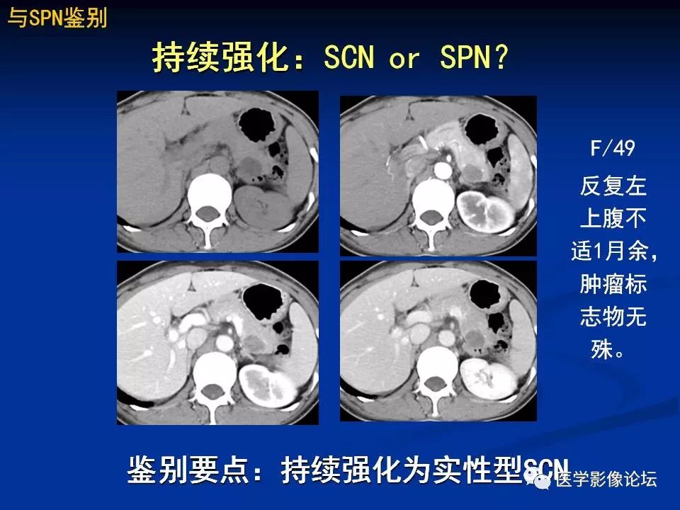 【PPT】胰腺囊性肿瘤影像学诊断与鉴别诊断