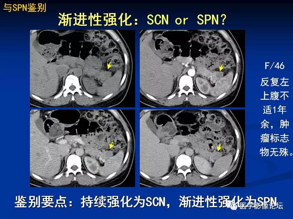 【PPT】胰腺囊性肿瘤影像学诊断与鉴别诊断