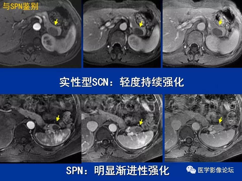 【PPT】胰腺囊性肿瘤影像学诊断与鉴别诊断