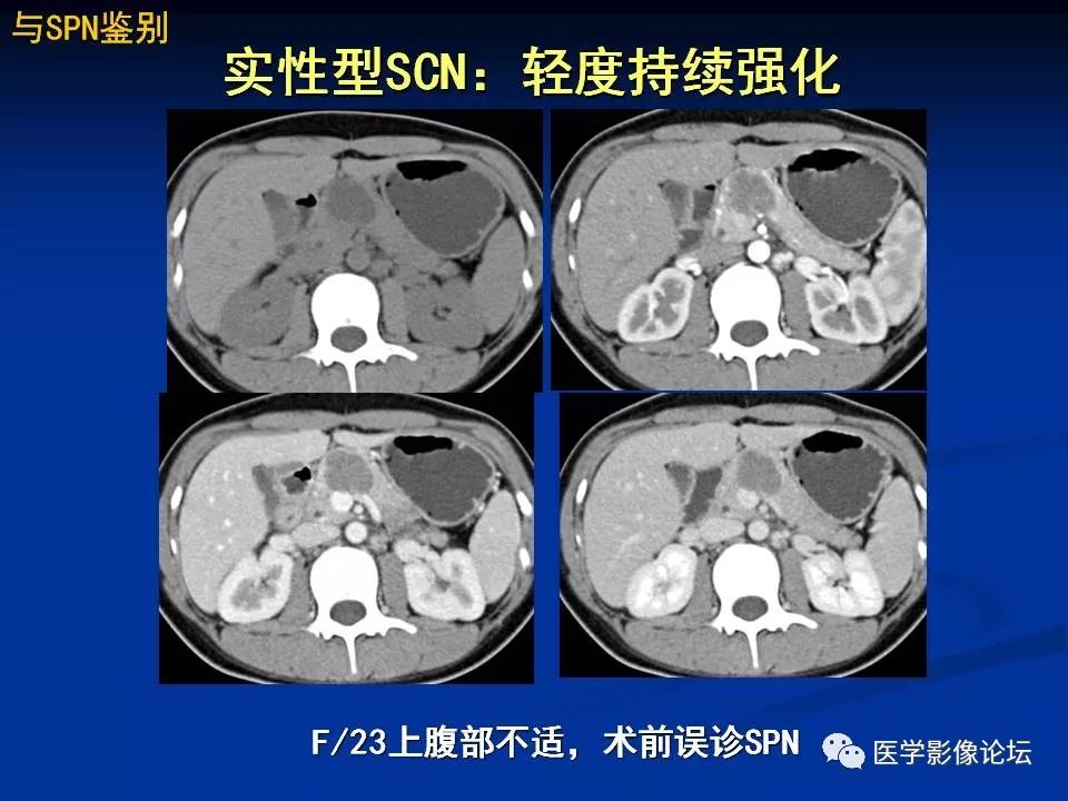 【PPT】胰腺囊性肿瘤影像学诊断与鉴别诊断