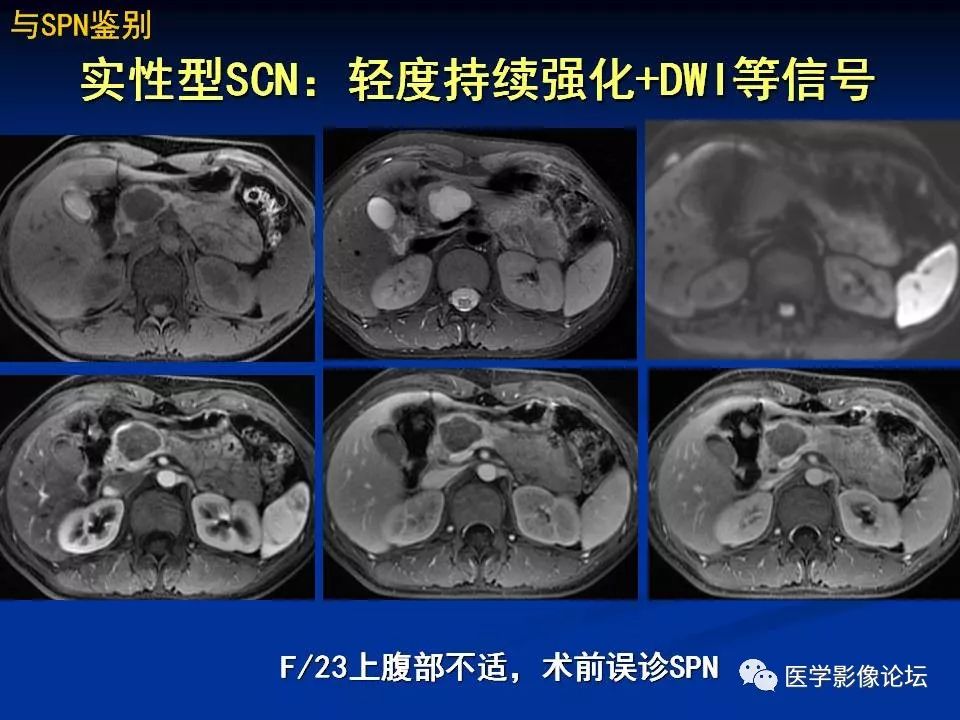 【PPT】胰腺囊性肿瘤影像学诊断与鉴别诊断