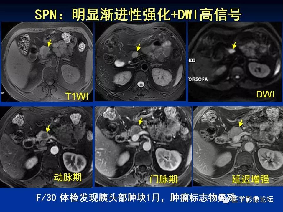 【PPT】胰腺囊性肿瘤影像学诊断与鉴别诊断