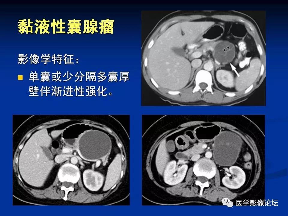 【PPT】胰腺囊性肿瘤影像学诊断与鉴别诊断