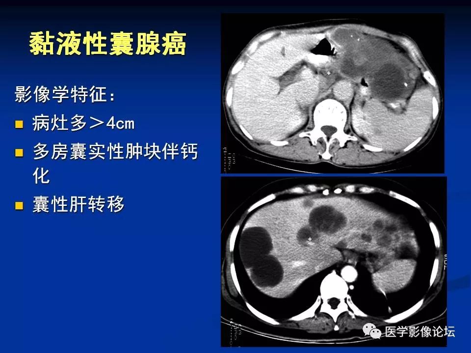 【PPT】胰腺囊性肿瘤影像学诊断与鉴别诊断