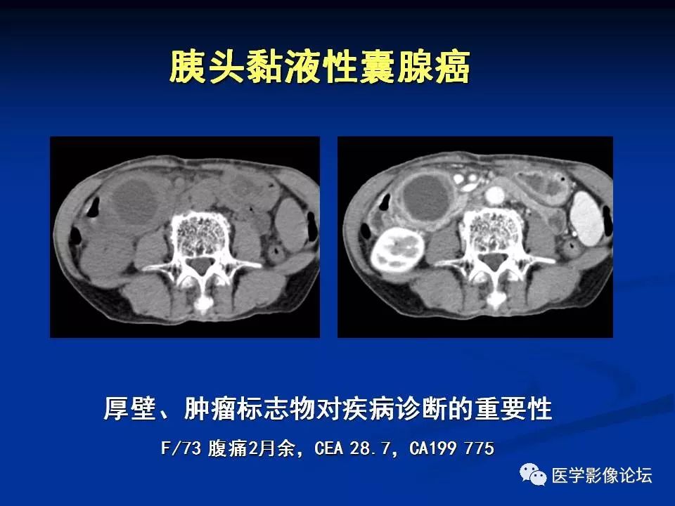 【PPT】胰腺囊性肿瘤影像学诊断与鉴别诊断