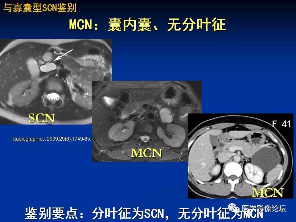 【PPT】胰腺囊性肿瘤影像学诊断与鉴别诊断
