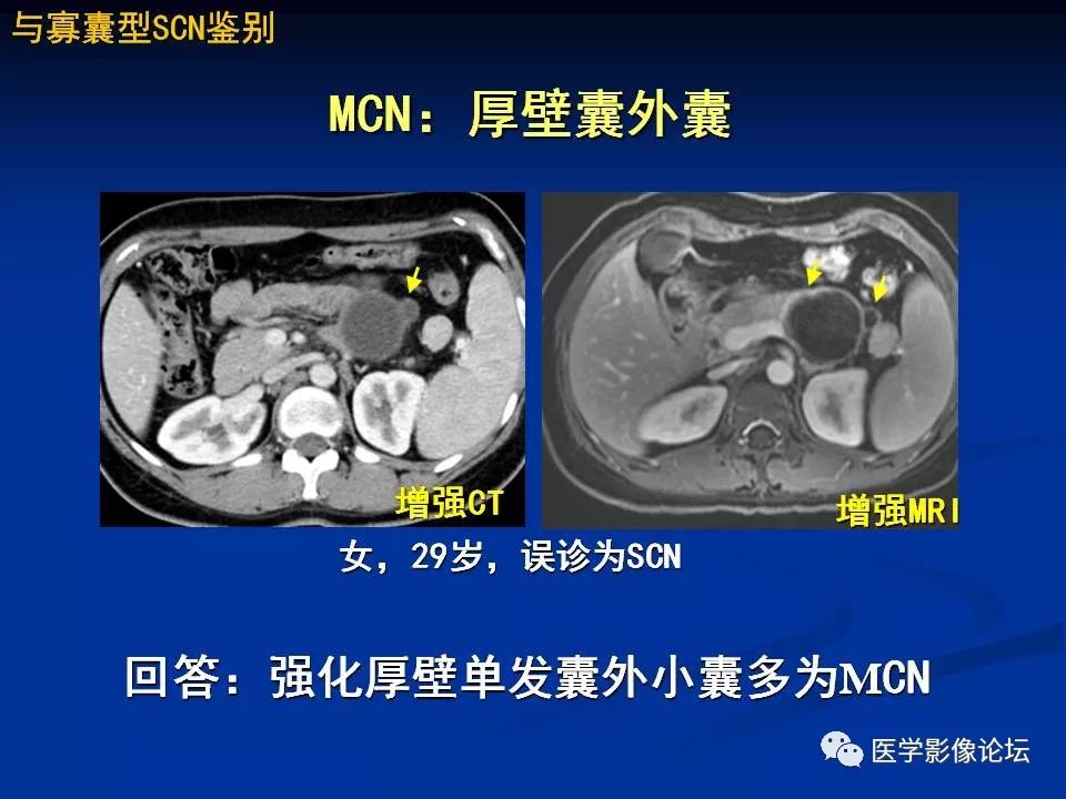 【PPT】胰腺囊性肿瘤影像学诊断与鉴别诊断