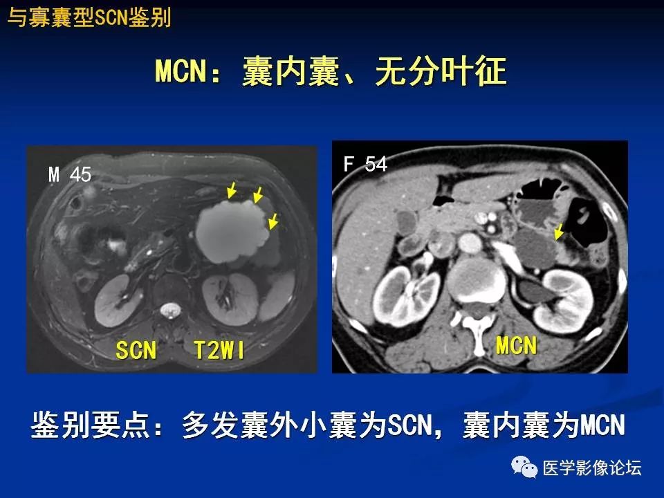 【PPT】胰腺囊性肿瘤影像学诊断与鉴别诊断