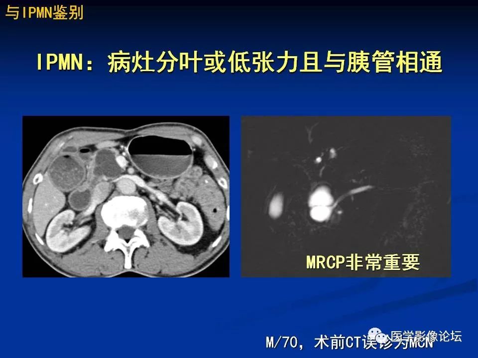 【PPT】胰腺囊性肿瘤影像学诊断与鉴别诊断