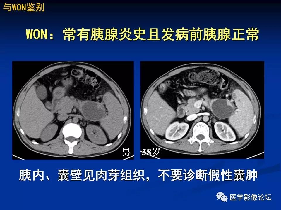 【PPT】胰腺囊性肿瘤影像学诊断与鉴别诊断