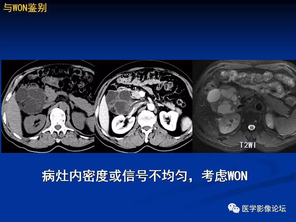 【PPT】胰腺囊性肿瘤影像学诊断与鉴别诊断