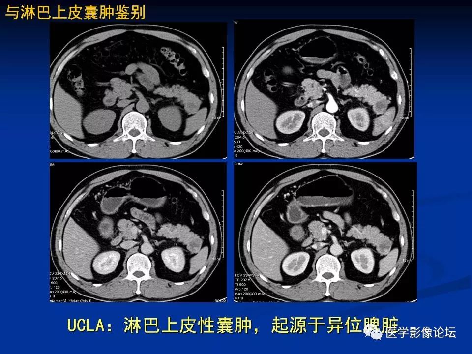 【PPT】胰腺囊性肿瘤影像学诊断与鉴别诊断