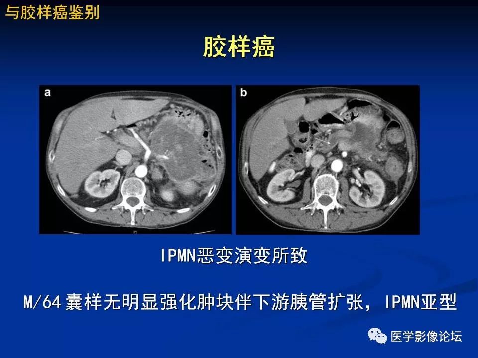 【PPT】胰腺囊性肿瘤影像学诊断与鉴别诊断