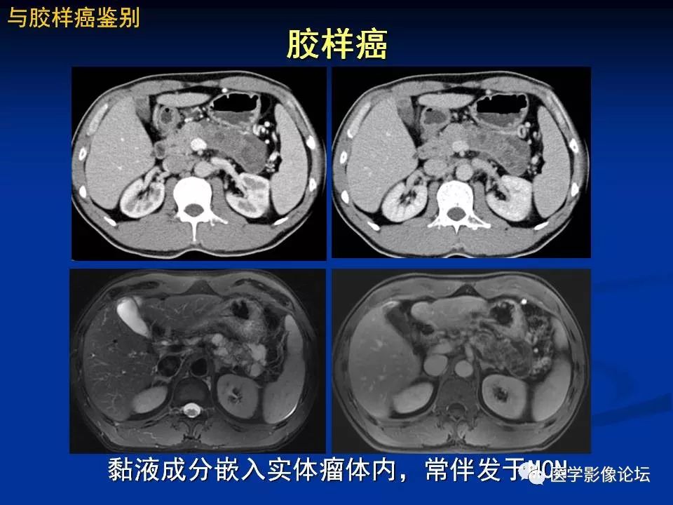 【PPT】胰腺囊性肿瘤影像学诊断与鉴别诊断