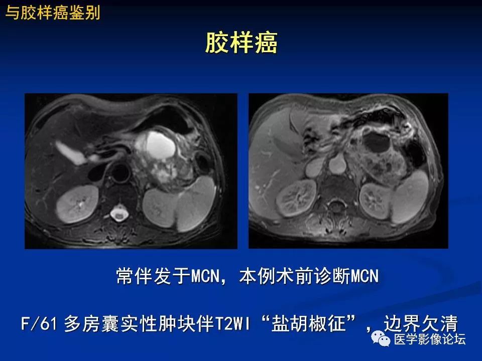 【PPT】胰腺囊性肿瘤影像学诊断与鉴别诊断