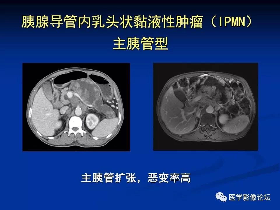 【PPT】胰腺囊性肿瘤影像学诊断与鉴别诊断