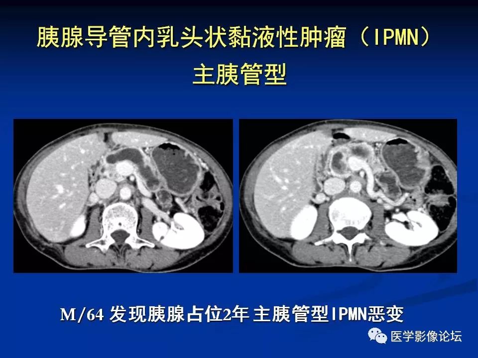 【PPT】胰腺囊性肿瘤影像学诊断与鉴别诊断