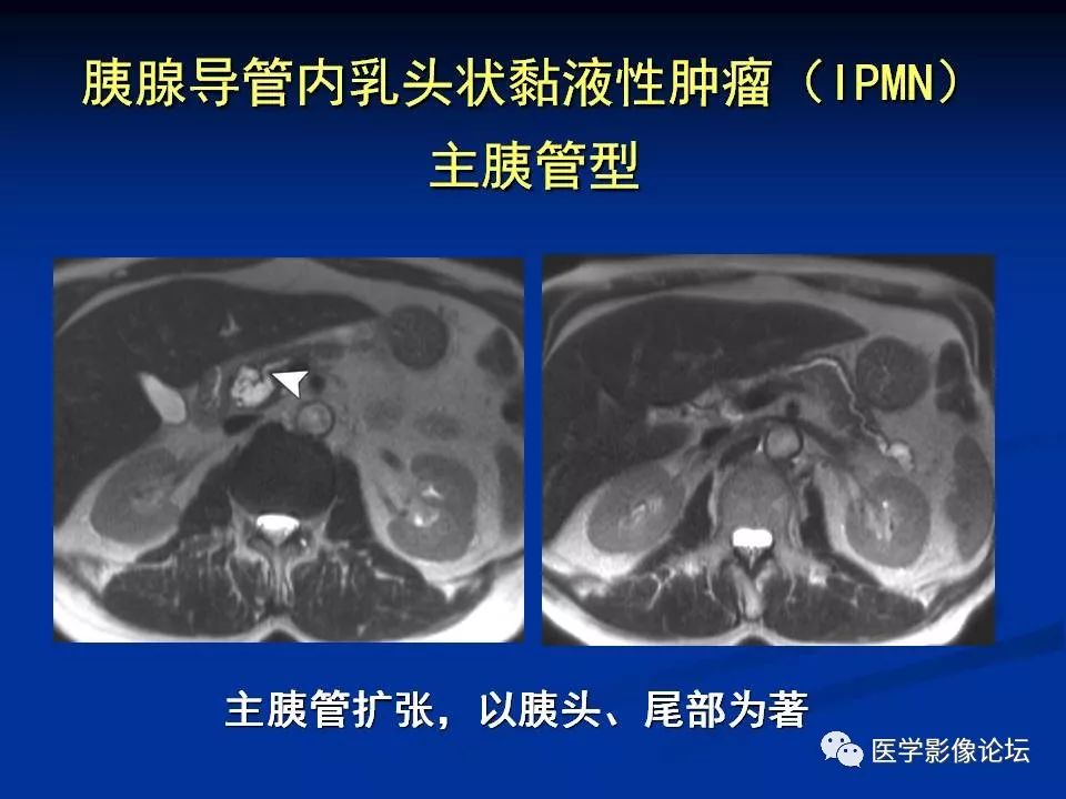 【PPT】胰腺囊性肿瘤影像学诊断与鉴别诊断