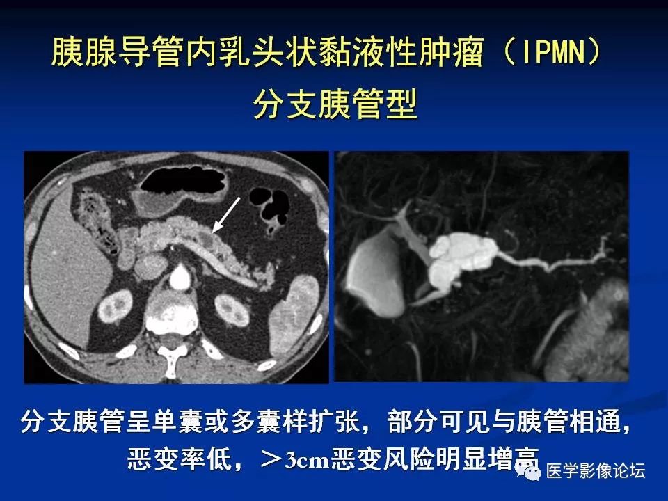 【PPT】胰腺囊性肿瘤影像学诊断与鉴别诊断