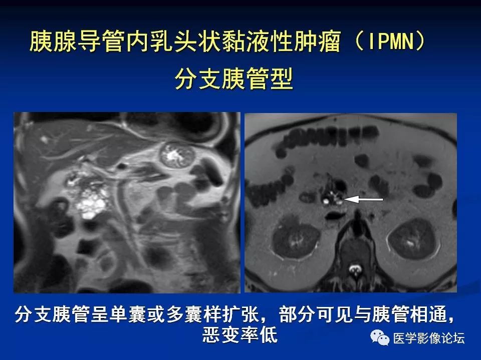 【PPT】胰腺囊性肿瘤影像学诊断与鉴别诊断