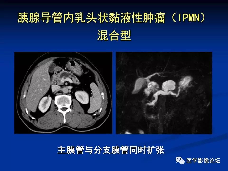 【PPT】胰腺囊性肿瘤影像学诊断与鉴别诊断
