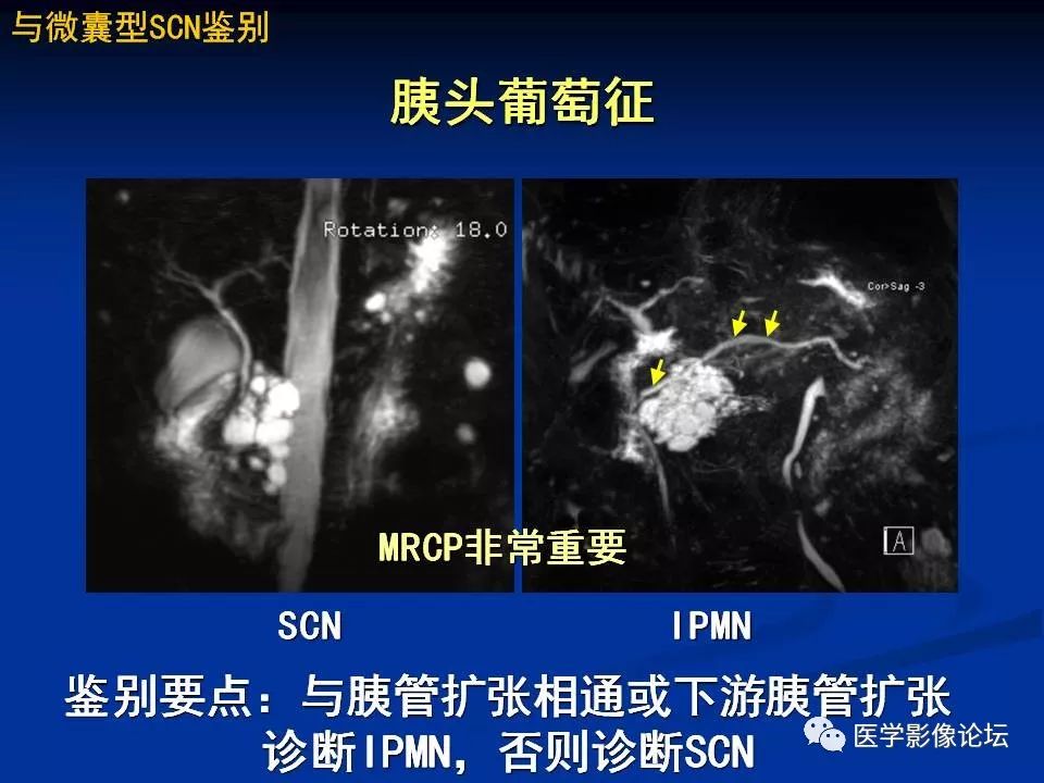 【PPT】胰腺囊性肿瘤影像学诊断与鉴别诊断