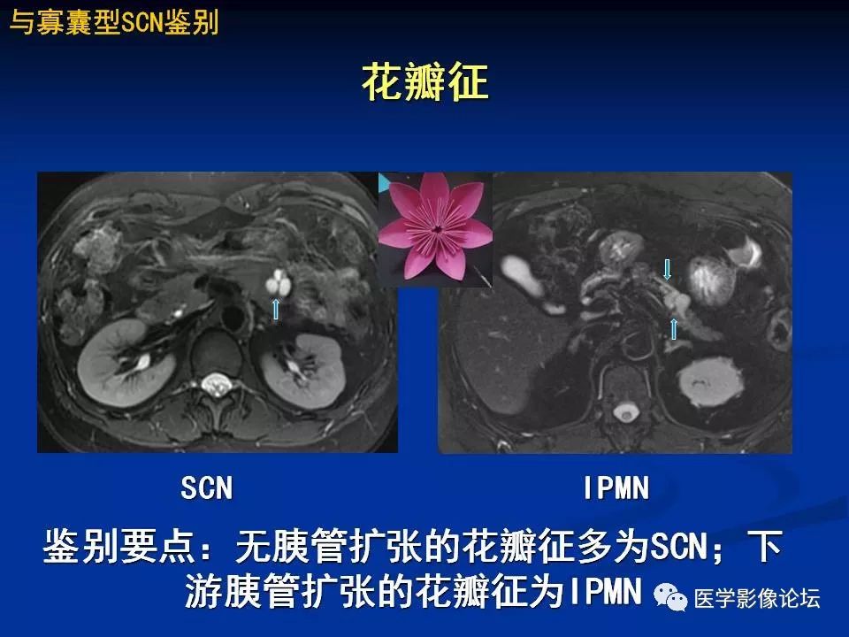 【PPT】胰腺囊性肿瘤影像学诊断与鉴别诊断