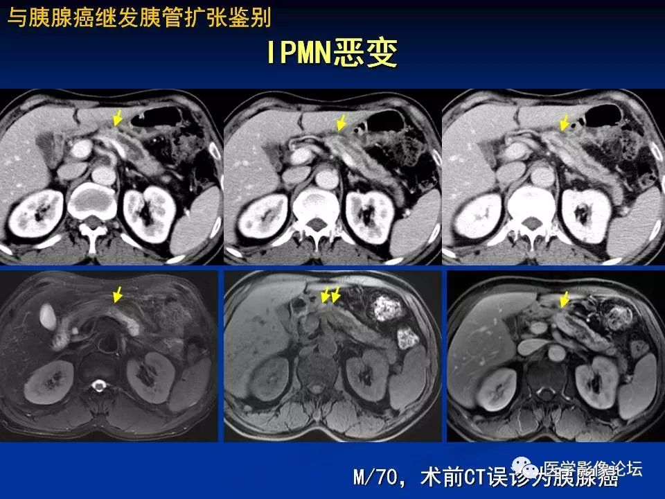 【PPT】胰腺囊性肿瘤影像学诊断与鉴别诊断
