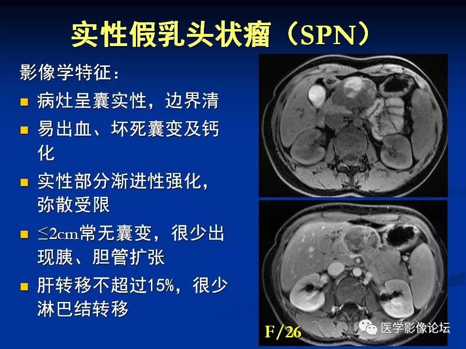 【PPT】胰腺囊性肿瘤影像学诊断与鉴别诊断