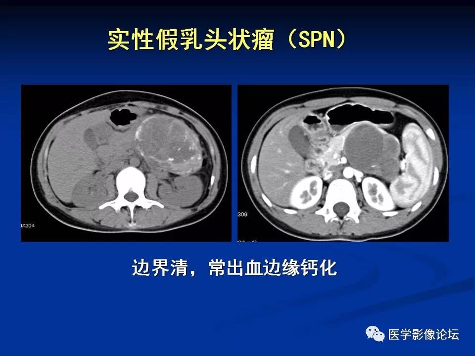 【PPT】胰腺囊性肿瘤影像学诊断与鉴别诊断