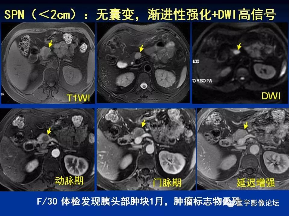 【PPT】胰腺囊性肿瘤影像学诊断与鉴别诊断