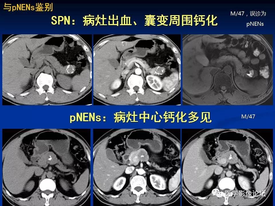 【PPT】胰腺囊性肿瘤影像学诊断与鉴别诊断